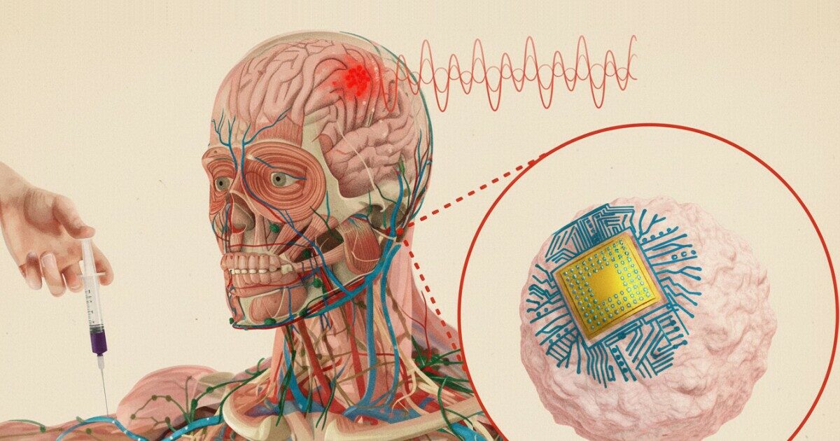bioelektronikus implantatumok agyi kezelese innovativ technologia