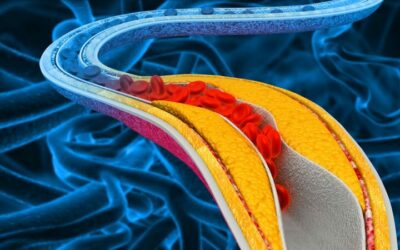 Új remény a magas koleszterinszint kezelésében: az enlicitide hatékonysága és biztonságossága